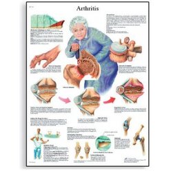 Schéma - artritída - 50x67 cm