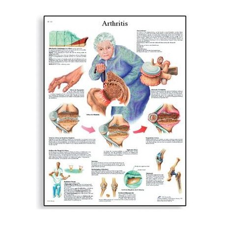 Schéma - artritída - 50x67 cm