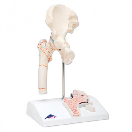 Zápal kostných kĺbov - model