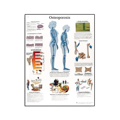 Schéma - osteoporóza - AJ - 50x67 cm