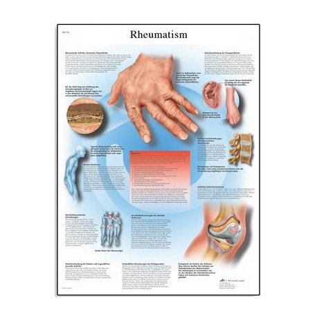 Schéma - reumatoidná artritída - AJ - 50x67 cm