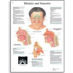 Schéma - rinitída a sinusitída - AJ - 50x67 cm
