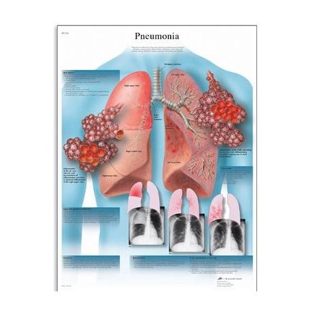 Schéma - pneumónia - AJ - 50x67 cm