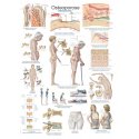 Schéma - osteoporóza