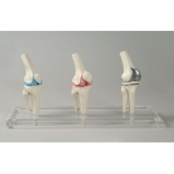 Model implantátu kolenného kĺbu