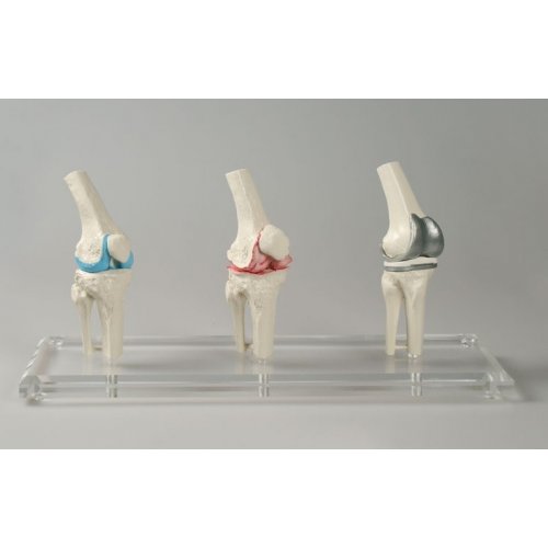 Model implantátu kolenného kĺbu