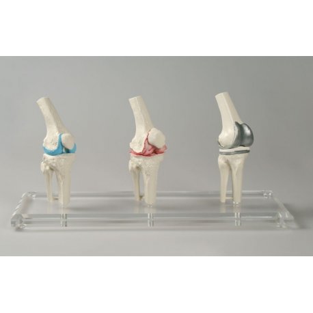 Model implantátu kolenného kĺbu