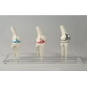 Model implantátu kolenného kĺbu