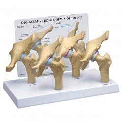 Štyri štádiá osteoartritídy bedrového kĺbu