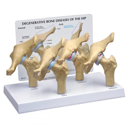 Štyri štádiá osteoartritídy bedrového kĺbu