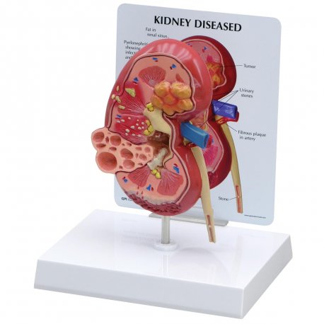 Model ľudskej obličky - anatomický - s ochorením