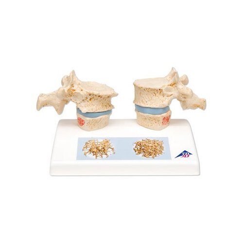 Model dvoch ľudských hrudných stavcov s osteoporózou