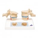 Model dvoch ľudských hrudných stavcov s osteoporózou