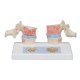 Model dvoch ľudských hrudných stavcov s osteoporózou